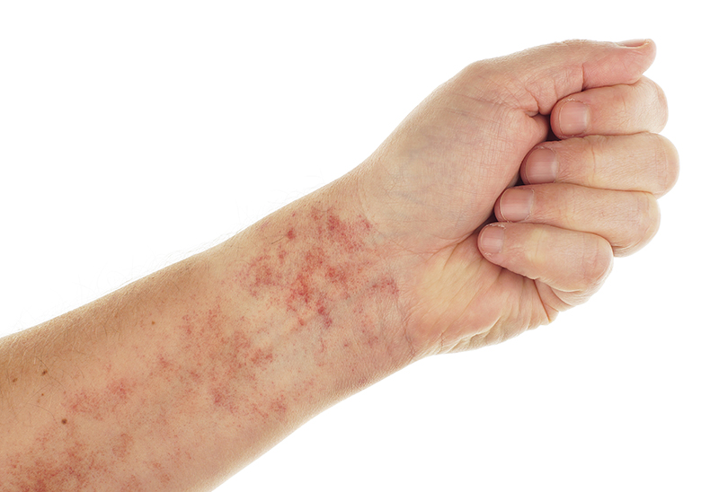 Xuất huyết dưới da là tình trạng máu chảy dưới da gây ra những vết bầm tím hoặc đốm đỏ