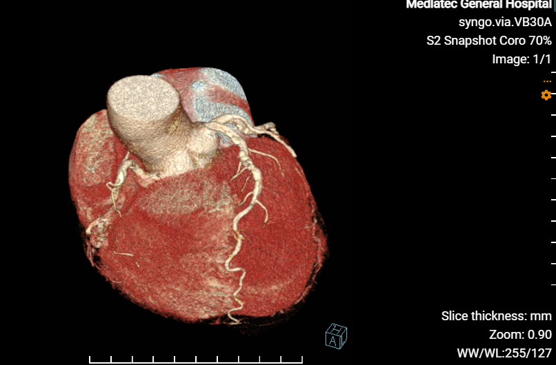 Hình hình họa chụp MSCT mạch đai  tại khám đa khoa MEDLATEC 