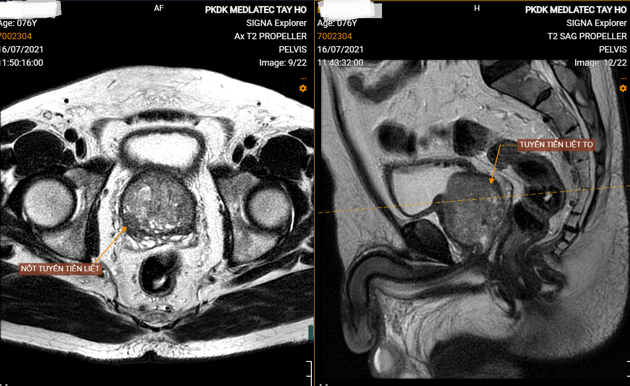 Nốt tuyến tiền liệt/ phì đại tuyến tiền liệt 