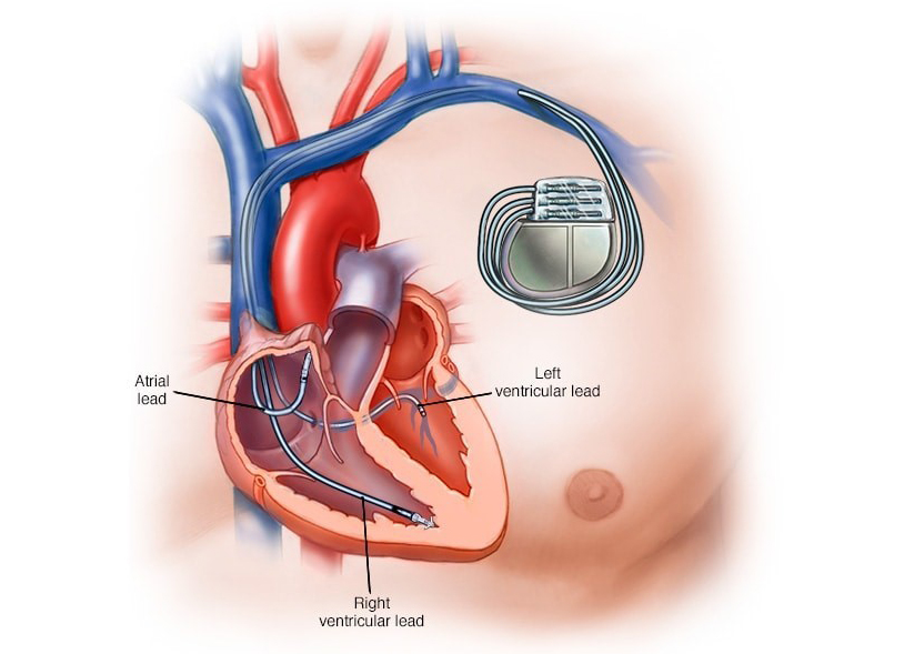 Máy tạo nhịp tim 