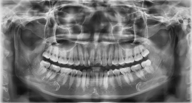 Hình ảnh chụp X-quang răng