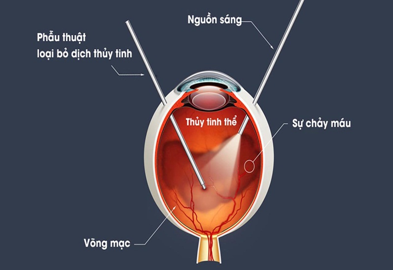 Phương pháp phẫu thuật có thể tiềm ẩn nhiều rủi ro