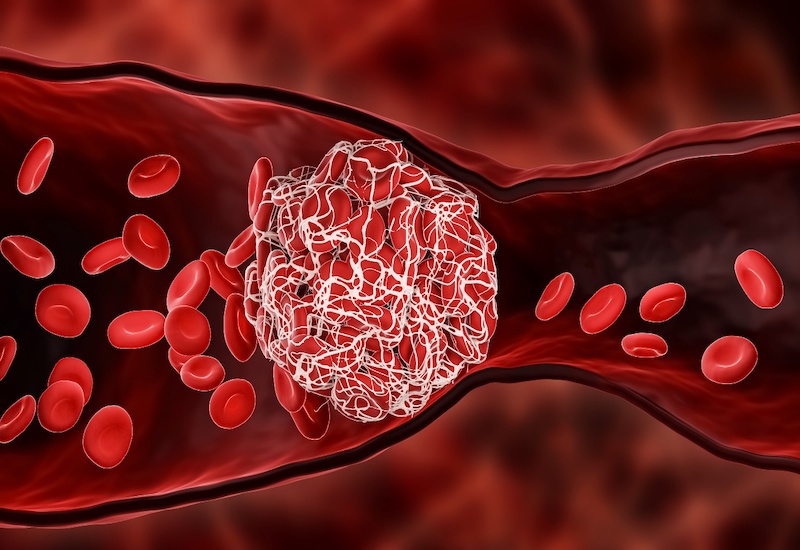 Cục máu đông chặn dòng chảy máu sẽ gây giãn tĩnh mạch thực quản