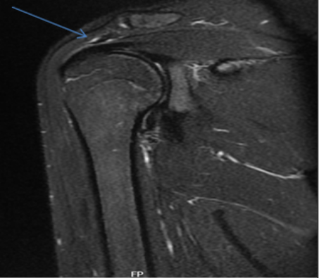 Hình ảnh dây chằng trên gai trên xung STIR của khớp vai phải 