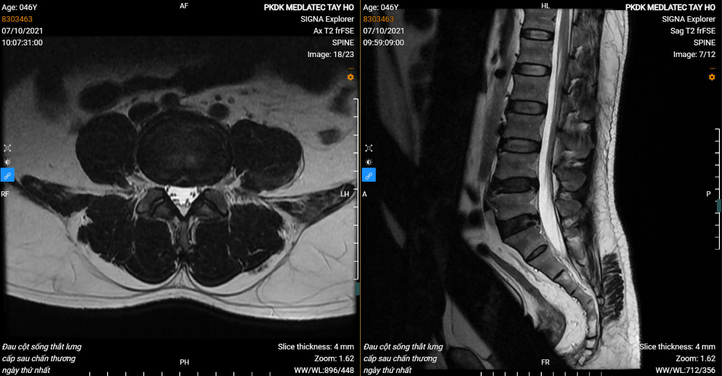 Chụp cộng hưởng từ cột sống thắt lưng