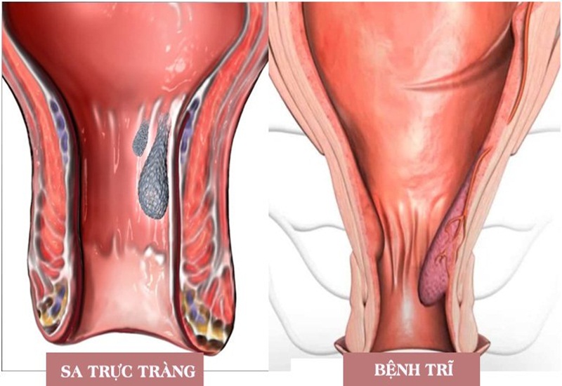 Sa đại tràng dễ bị nhầm với bệnh trĩ