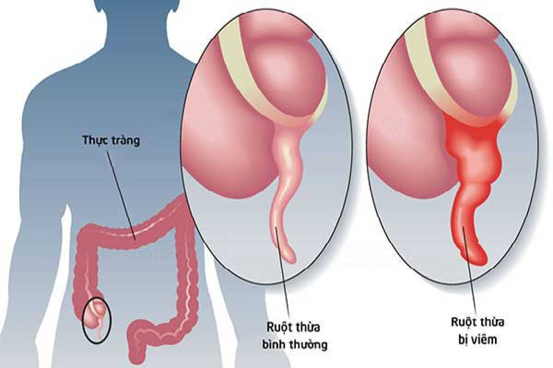 Viêm Ruột Thừa Tiểu Khung: Triệu Chứng Nguy Hiểm và Phương Pháp Điều Trị Hiệu Quả