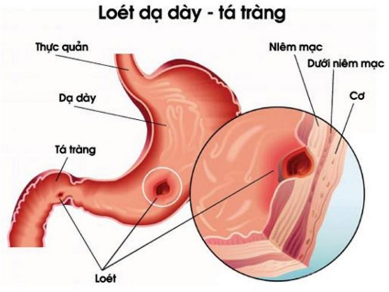 Viêm loét hành tá tràng gây nhiều ảnh hưởng đến sức khỏe và cuộc sống của người bệnh