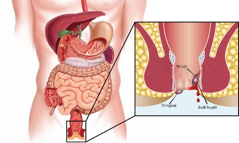 Trĩ là bệnh thường gặp gây nhiều đau đớn và bất tiện cho người bệnh