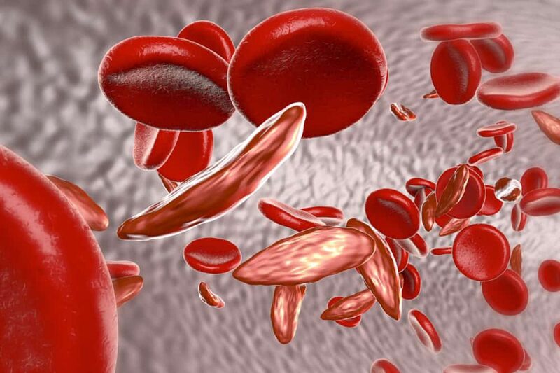 Chỉ số RDW có nhiều giá trị trong chẩn đoán các bệnh về máu