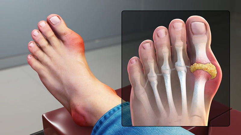 Bệnh Gout là một trong những yếu tố nguy cơ dẫn đến viêm bao gân cổ tay