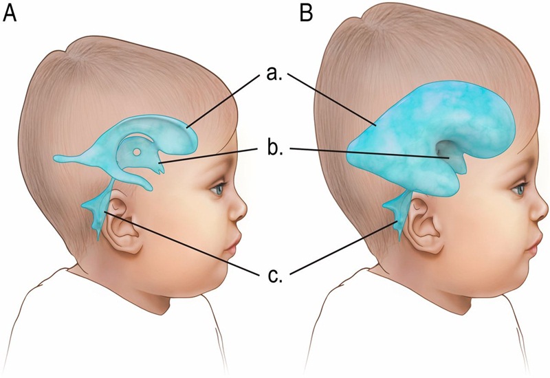 Chu vi vòng đầu của bé lớn bất thường có thể do bệnh não úng thủy