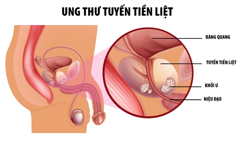 Ung thư tiền liệt tuyến rất dễ xảy ra ở nam giới sau độ tuổi 65