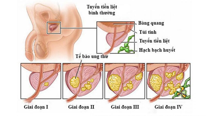 Xét nghiệm PSA dương tính nghĩa là người bệnh có nguy cơ ung thư tuyến tiền liệt cao hơn