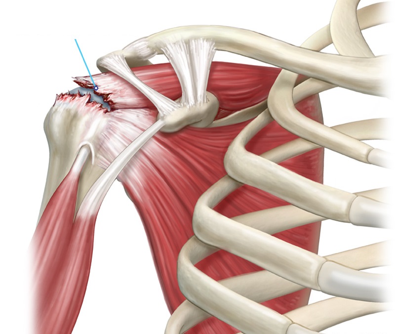 Rách cơ chóp xoay là tình trạng các cơ quay ở khớp vai bị đứt hoặc rách một phần