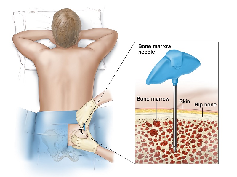 Sinh thiết tủy xương được sử dụng để phát hiện một số bệnh lý nguy hiểm