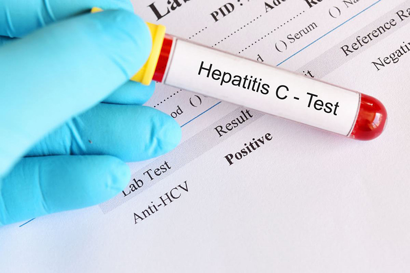 Xét nghiệm Anti-HCV giúp tìm kháng thể Hepatitis C Virus có trong máu