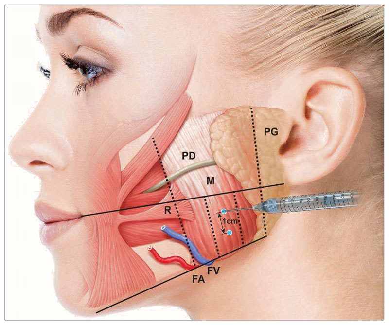 Tiêm Botox giúp cải thiện chứng nghiến răng và thư giãn cơ hàm