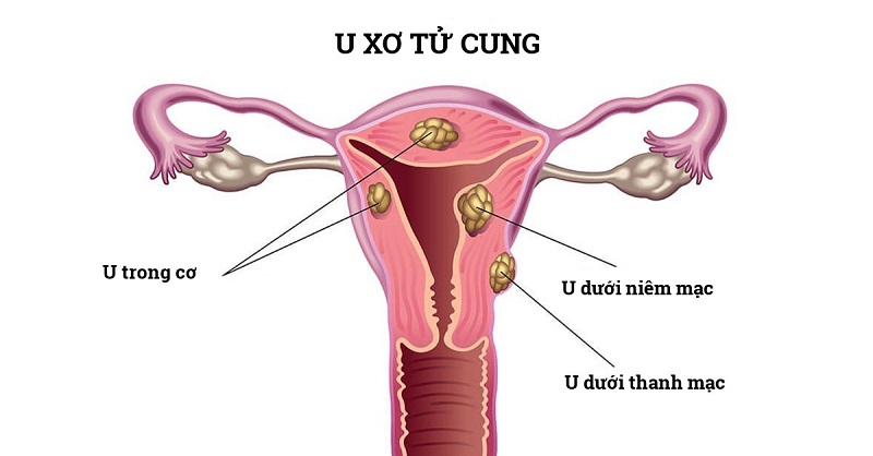U xơ tử cung hầu hết là khối u lành tính, chủ yếu xuất hiện ở phụ nữ sau 30 tuổi