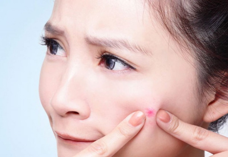 Những lưu ý chăm sóc da sau nặn mụn để ngăn ngừa sẹo hiệu quả
