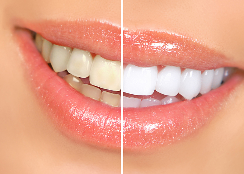 Học ngay 6 cách làm trắng răng cấp tốc cho bạn nụ cười tỏa nắng