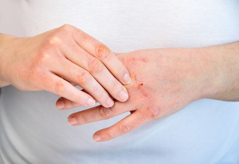 Top 3 nguyên nhân da tay khô và cách điều trị hiệu quả