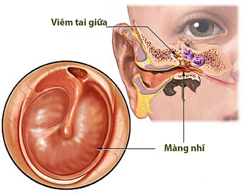 Trẻ 6 - 36 tháng dễ bị viêm tai giữa vì hệ miễn dịch chưa hoàn thiện