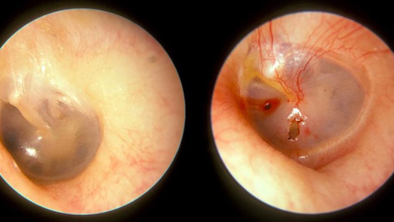 Thủng màng nhĩ là một biến chứng viêm tai giữa phổ biến ở trẻ