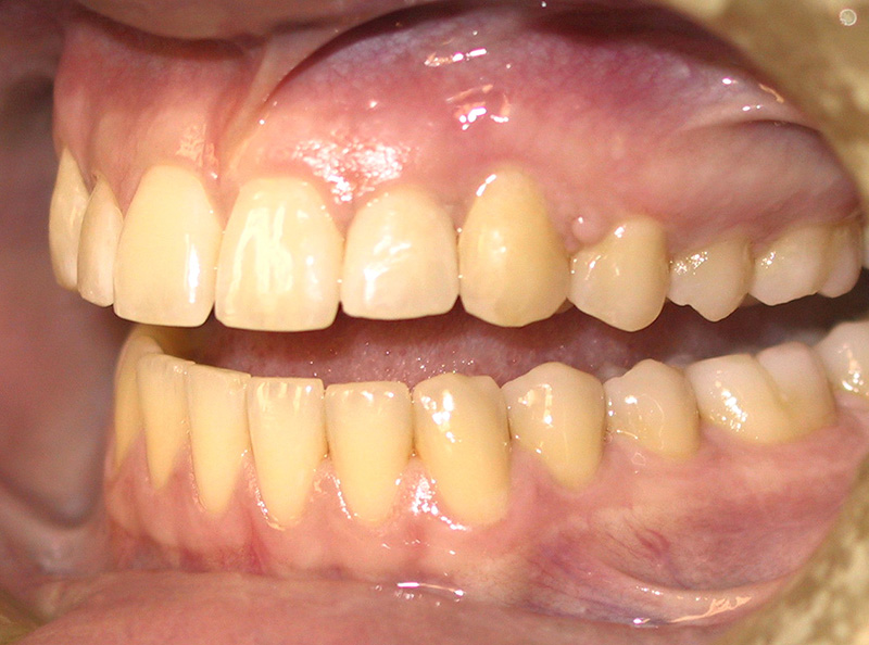 Răng ố vàng là tình trạng men răng bị bào mòn, màu răng trở nên xỉn màu, chuyển từ vàng nhạt sang đen sạm