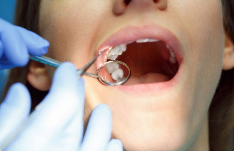 Răng khôn mọc lệch, không đúng vị trí gây nên tình trạng viêm nhiễm, ảnh hưởng đến chức năng ăn nhai