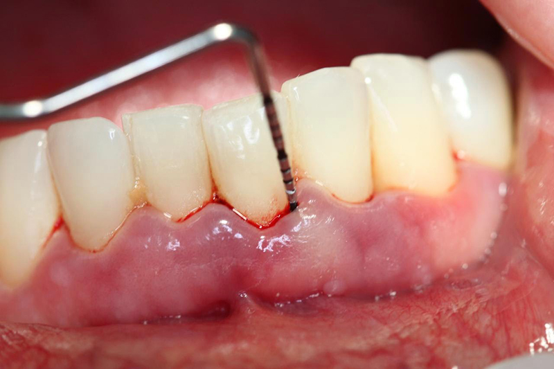 Viêm nha chu là một trong những nguyên nhân gây nên tình trạng viêm chân răng có mủ