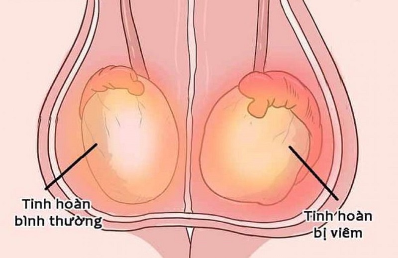 Tình trạng sưng đỏ ở người bị viêm tinh hoàn