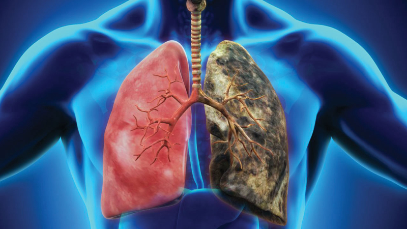 Chỉ số PDW quá cao có thể là triệu chứng của ung thư phổi