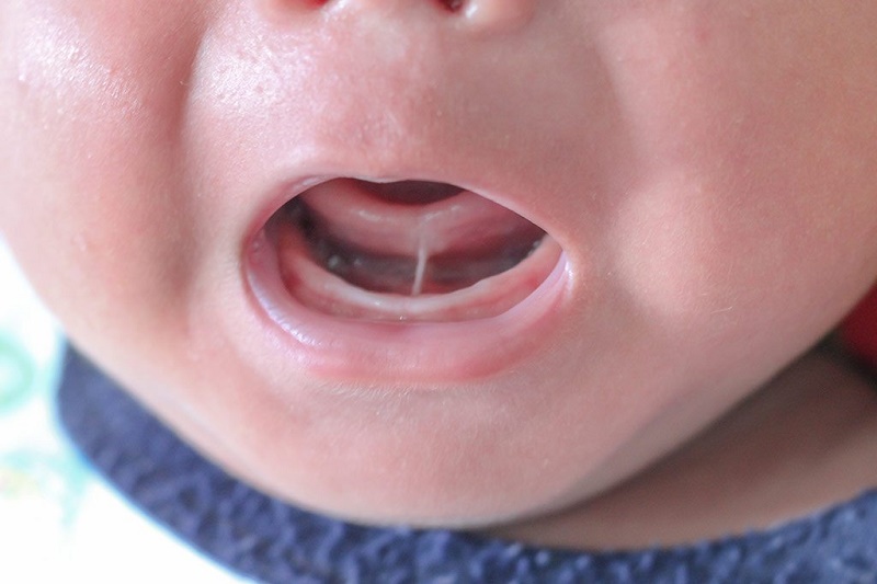 Tìm hiểu về bệnh dính thắng lưỡi và cách chữa trị hiệu quả | Medlatec