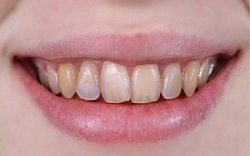 Các phương pháp làm trắng răng an toàn, ai cũng có thể thực hiện | Medlatec