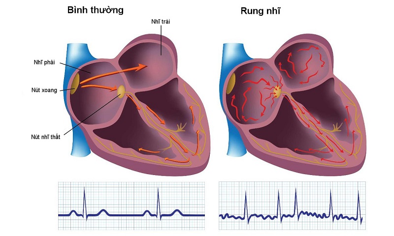 Rối loạn nhịp tim trong rung tâm nhĩ