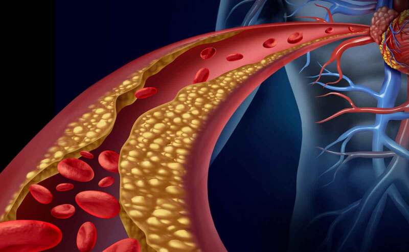 Rối loạn lipid máu là yếu tố hàng đầu gây biến chứng tim mạch nguy hiểm