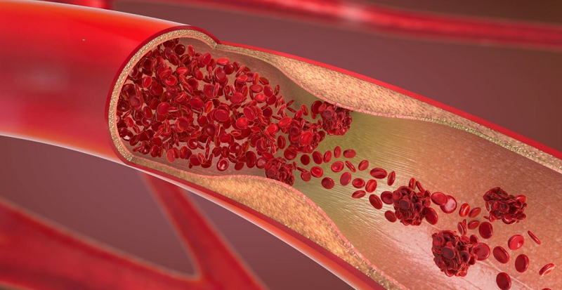 Khi lượng máu đến tim bị ít đi sẽ gây ra thiếu máu cơ tim