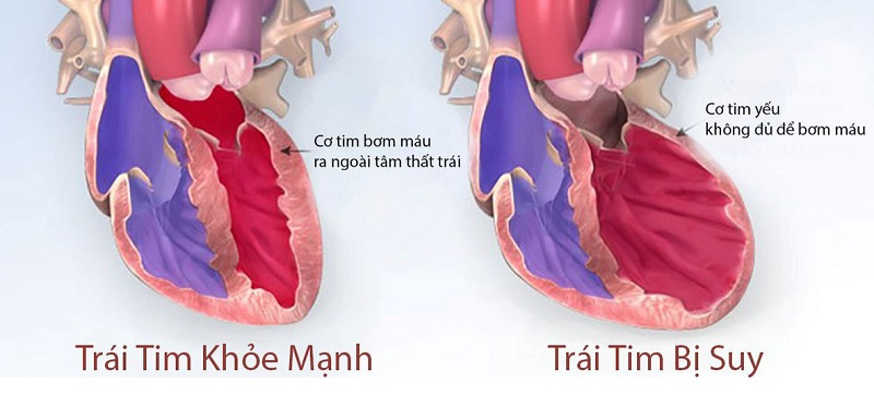 Bệnh suy tim khiến cho khả năng bơm máu của cơ tim không được như bình thường