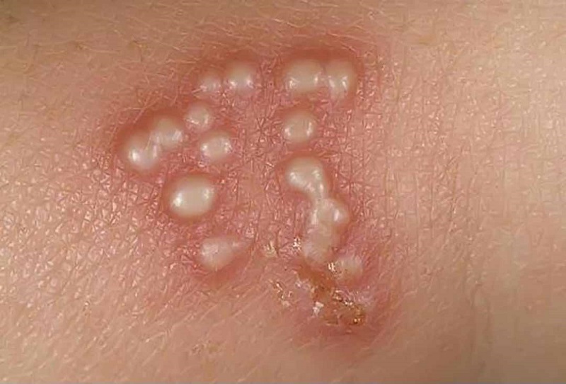 Mụn rộp có nước, gây đau đớn là dấu hiệu điển hình của bệnh herpes