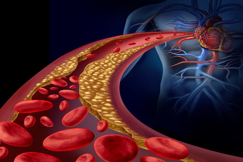 Rối loàn lipid huyết là bị bệnh gì - những điều chúng ta nên biết! | Medlatec