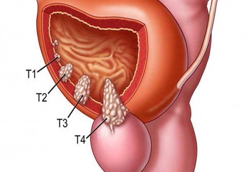 Ung thư bàng quang phát triển qua từng giai đoạn