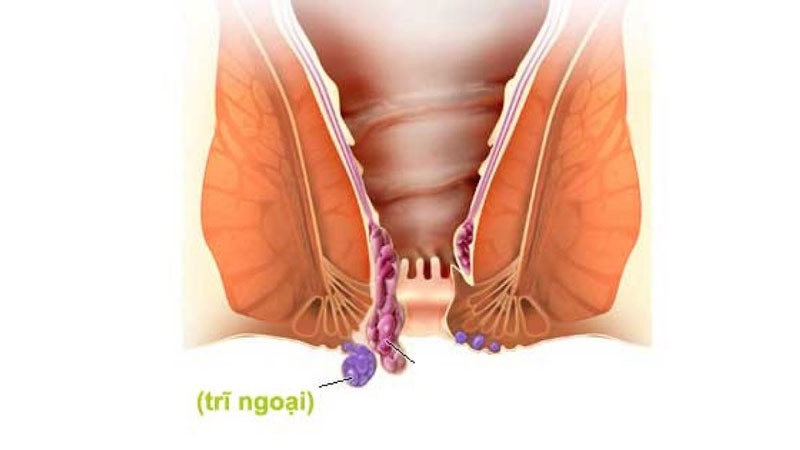 triệu chứng bệnh trĩ