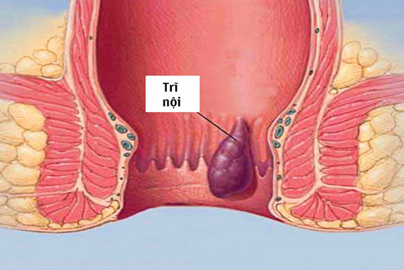 Trĩ nội là gì?