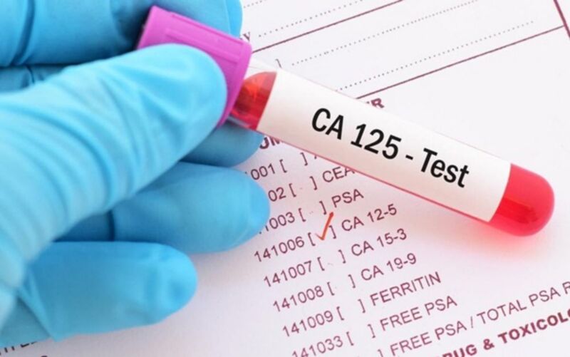 Xét nghiệm CA 125 giúp phát hiện ung thư buồng trứng