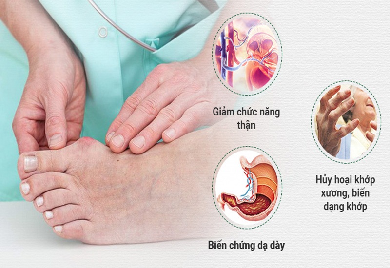 Bệnh giả Gout khó chữa dứt điểm và có thể gây ra nhiều biến chứng nguy hiểm