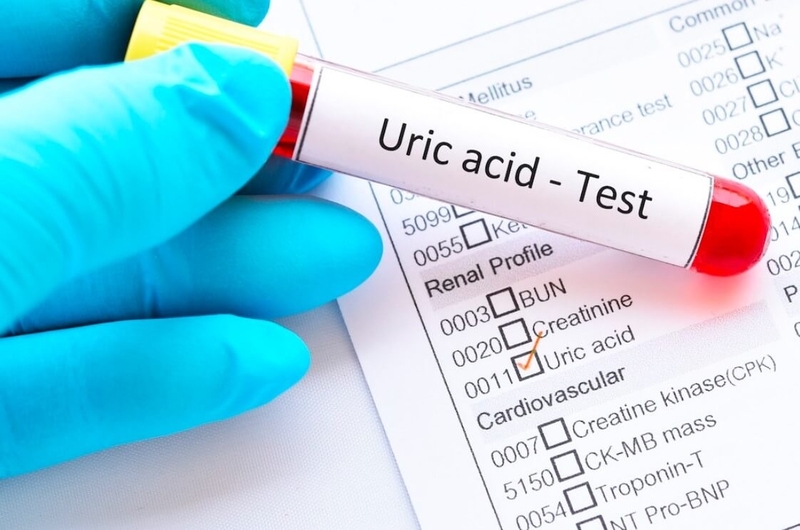  Xét nghiệm acid uric trong máu để đánh giá chức năng thận