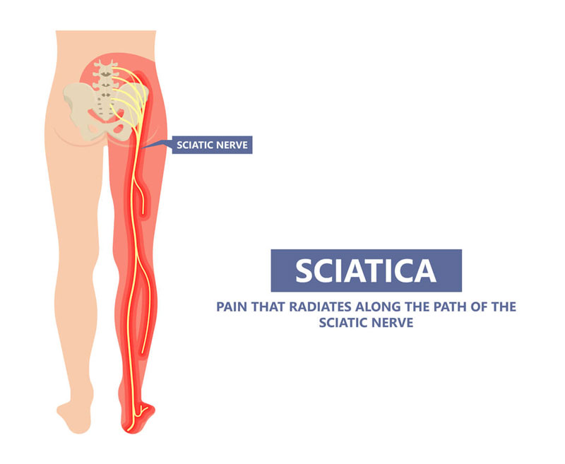 Đau thần kinh tọa ảnh hưởng tới sinh hoạt của bệnh nhân