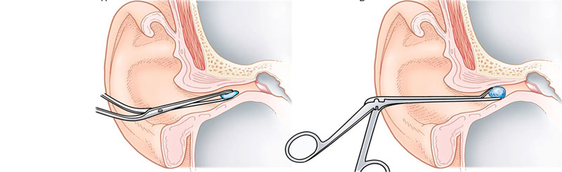 Người bị dị vật kẹt trong tai nên đến gặp bác sĩ chuyên khoa để điều trị