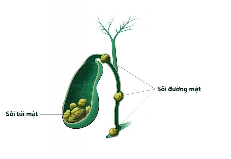 Sỏi có thể nằm trong túi mật hoặc trong đường mật